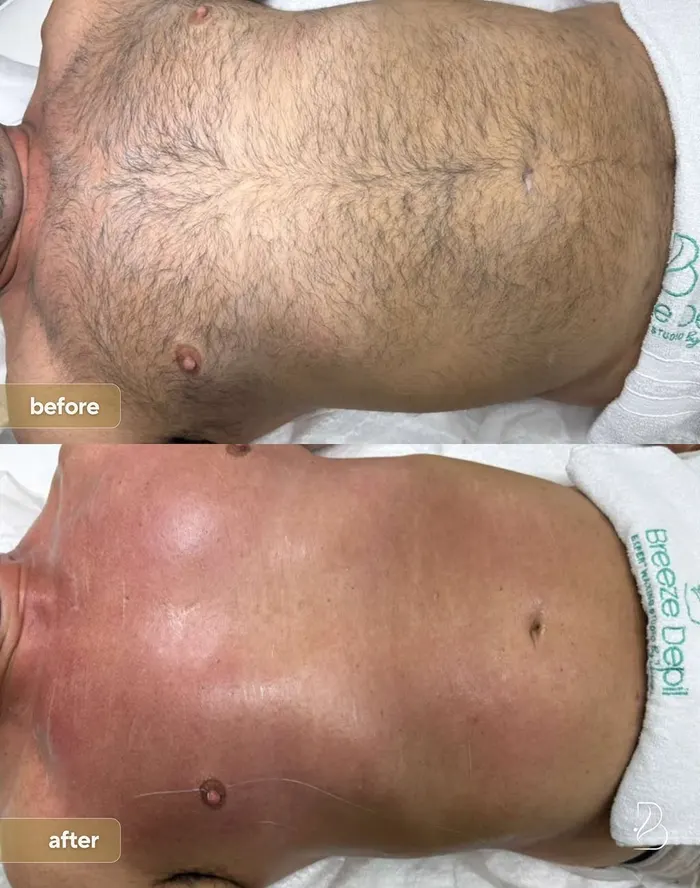 Full chest wax before and after
