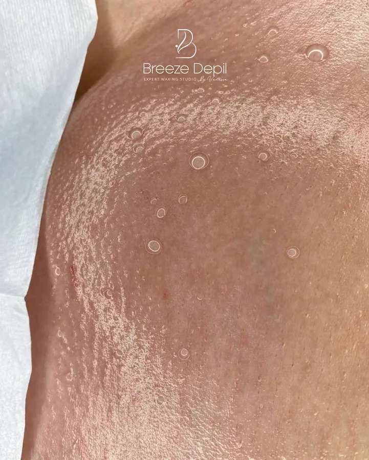 Vajacial treatment results at Breeze Depil
